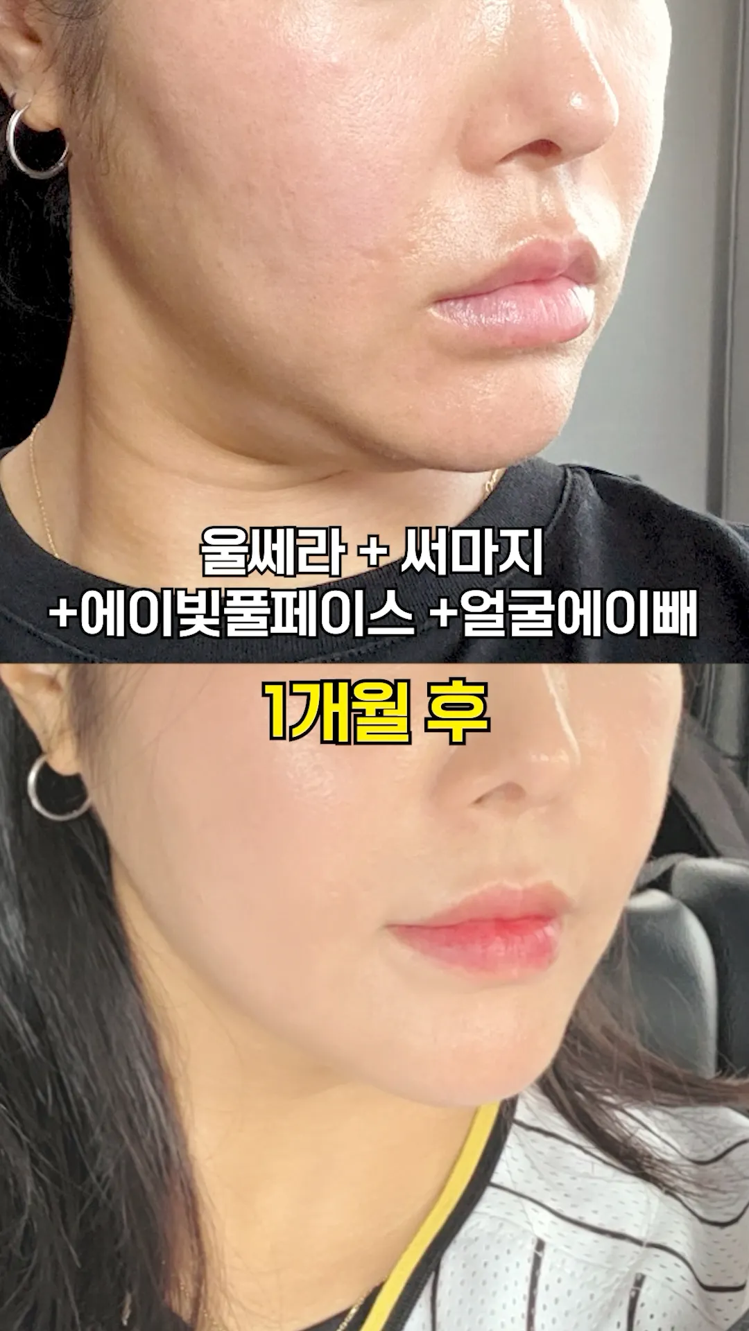 탄력이랑 윤곽 잡아주는 시술