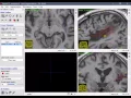 Fast manual lesion segmentation in ITKsnap