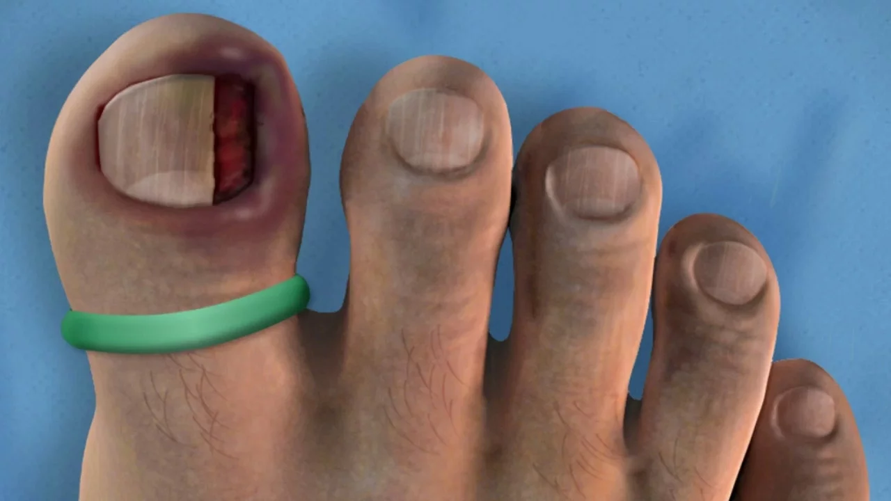 JAM IT IN THERE - Ingrown Toenail and TURKEY Surgery
