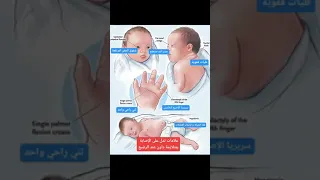 علامات تدل على الإصابة بمتلازمة داون عند الرضيع 