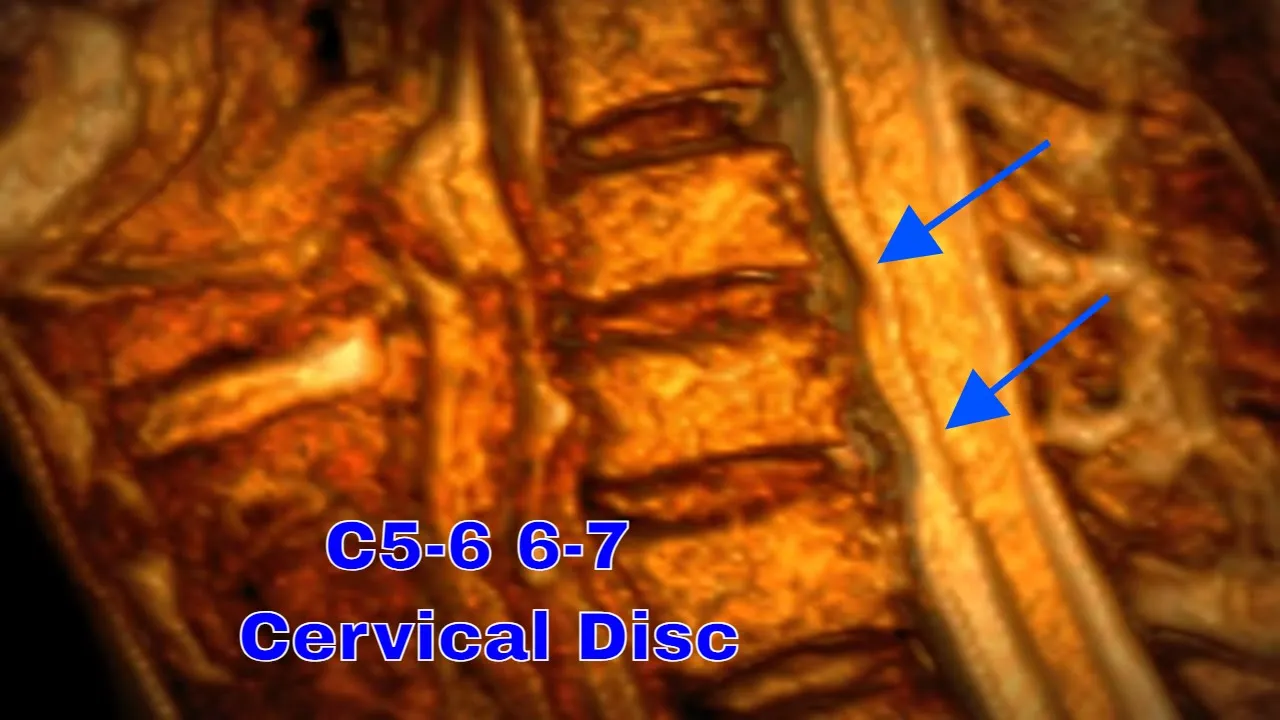 Education video on Herniated Cervical Discs by Dr. Gary Simonds, former Chief of Neurosurgery at Car. 