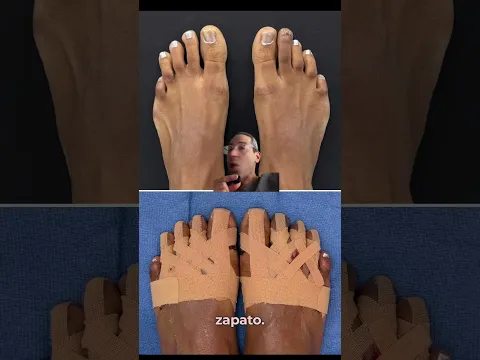 SURGERY TO MAKE FEET SMALLER?😱#footreductionsurgery #shorts #cosmeticfootsurgery