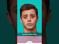 Download Lagu Dark Circles Under Eyes? 3 Reasons Which May Causes Dark Circles.