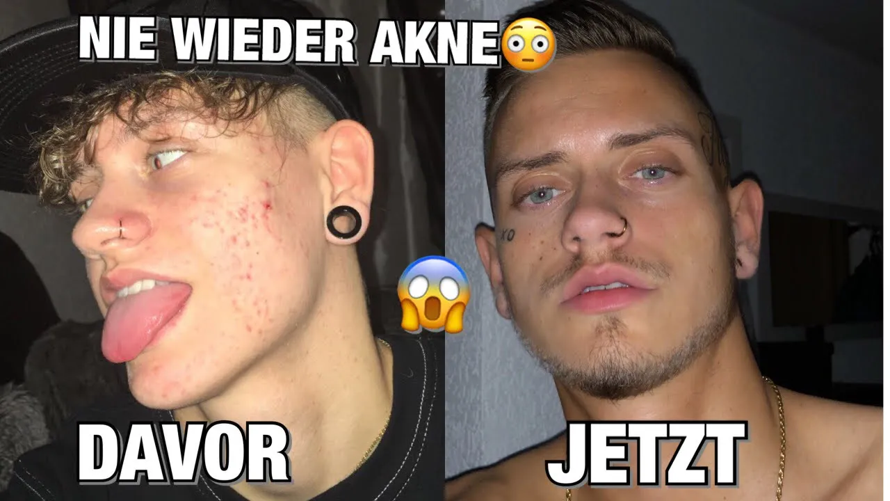 
          
          
          
            
            NIE WIEDER AKNE (PICKEL) 😳 MEIN WUNDERMITTEL😱
          
        . 