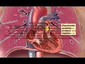 Download Lagu Bacterial Endocarditis