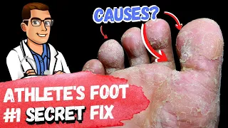 Download 🦶BEST 9 Athlete's Foot Fungus Remedies [\u0026 the #1 Big Mistake]🦶 MP3