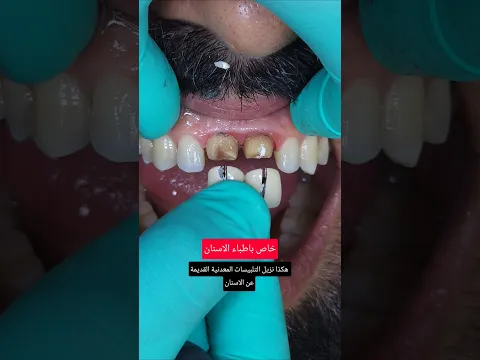 هكذا نزيل التلبيسات المعدنية القديمة عن الاسنان