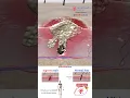 Ingrown Hair Laser Treatment Medical Arts 3D Animation