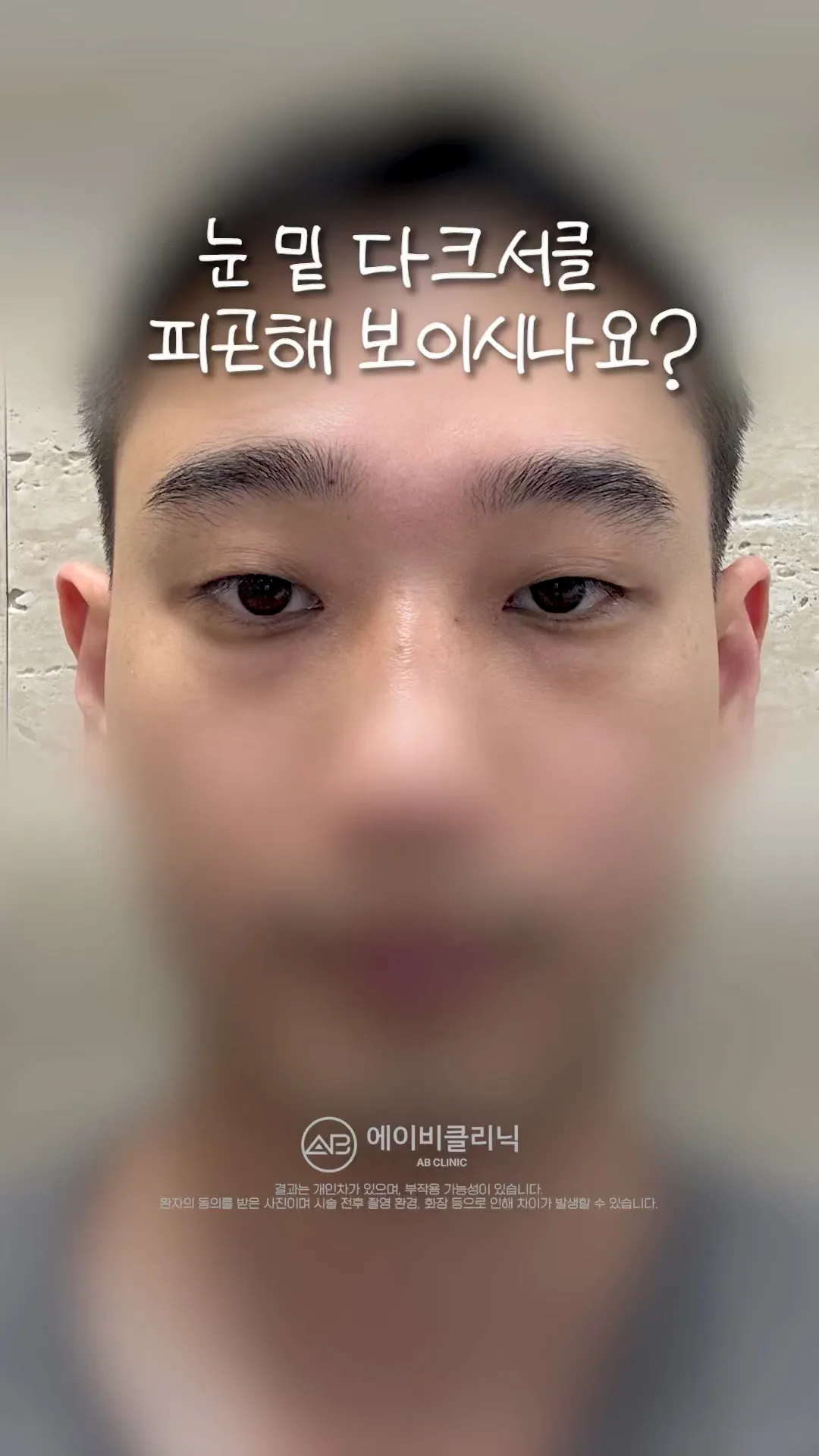 다크서클 지우개 리얼 후기 ✨