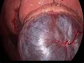 Resection of external cardiac tumor CPT code - simplify medical coding