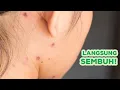 Download Lagu Inilah Cara Mengatasi Cacar Air Agar Tidak Menyebar