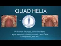 Quad helix appliance in Orthodontics