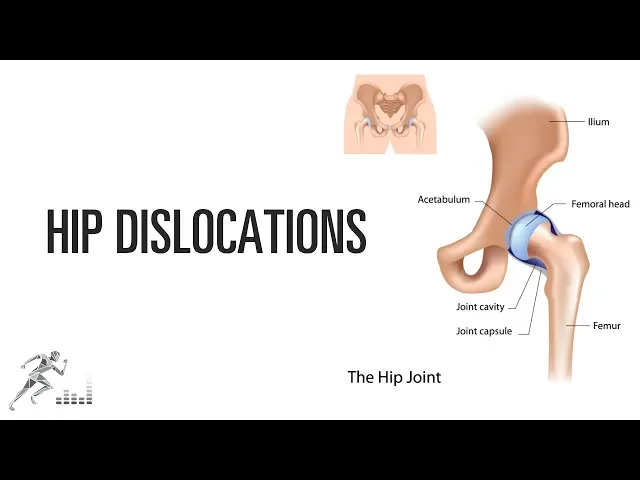 Hip dislocation