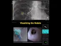 Direct visualization of the lung nodule