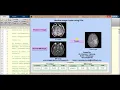 Medical Image fusion using PCA Matlab Project Source Code