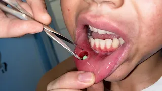 Ele pensou que era apenas um doce. Não VEJA se você é sensível