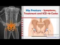 Hip Fracture - Symptoms Treatment and ICD-10 Codes