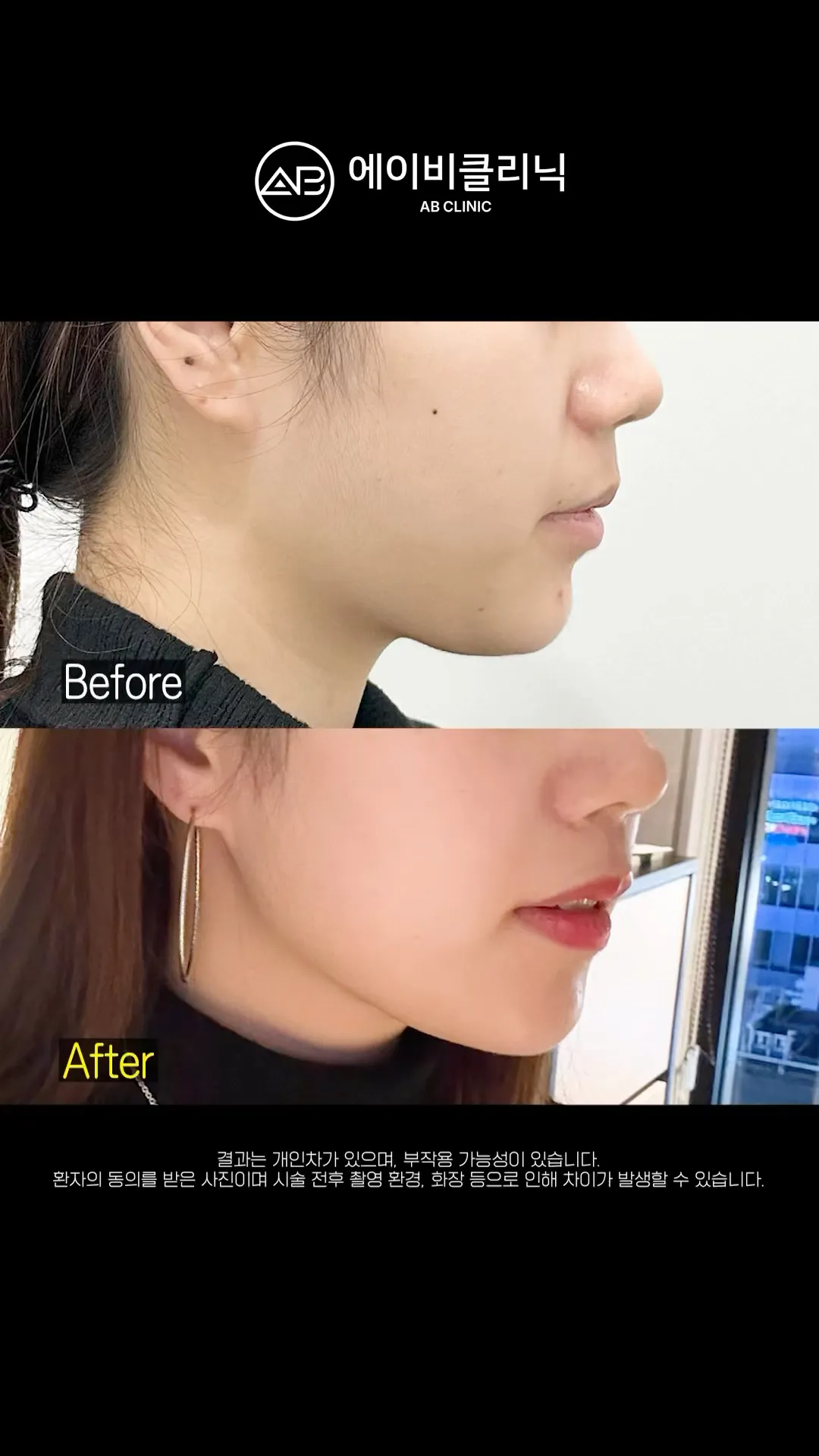 울쎄라 통증 땜에 미뤘다면 이렇게 해보세요!✅