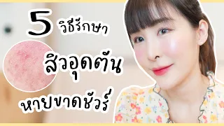 สิวอุดตันเกิดจากสาเหตุอะไรบ้าง