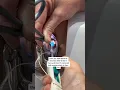 This is how an IUD is inserted