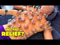 Fire Cupping in Vietnam ASMR