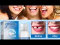 Tooth Repair Granules Temporary Broken Tooth Repair Kit Review 2022 Does It Work