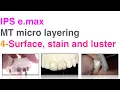 Download Lagu IPS e max MT micro layering 4 Surface, stain and luster