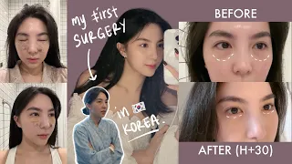 My FIRST SURGERY in Korea 🇰🇷 + PRICE | Undereye Fat Removal | VLOG