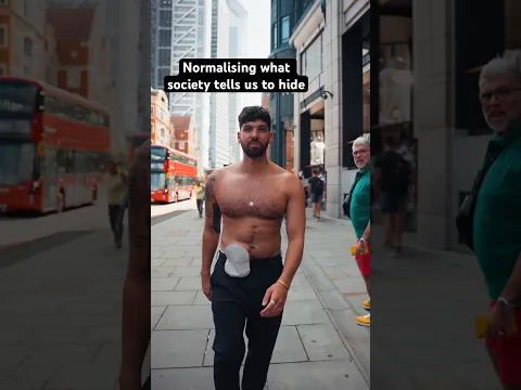 For years, I felt like my stoma was something I needed to cover up. Now, I’m proud to show it.