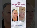 Download Lagu BEFORE AND AFTER HIFU TREATMENT #hifu #hifutreatment #hifufacial