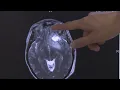 MedWatch Daily Digest The effects of COVID-19 on the brain and more