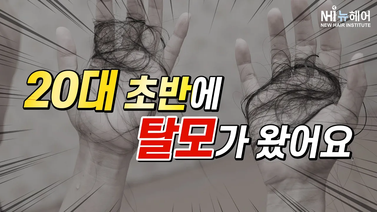탈모가 20대 초반에 찾아 왔어요 - 뉴헤어 I 탈모치료