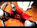 Download Lagu ALIF  (University Hospital Brugmann - Brussels 2012)