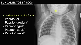 COMO AVALIAR QUALQUER RAIO X DO TÓRAX? O ABCDE DO TÓRAX - AULA 1
