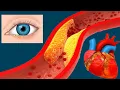 Download Lagu Familial Hypercholesterolemia (FH): Causes And Symptoms