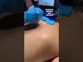 Hydrafacial Clarifying Back Treatment for Acne