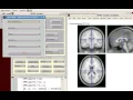 SPM Parameter Extraction with Marsbar