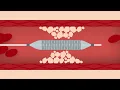 Download Lagu Heart Stent Procedure