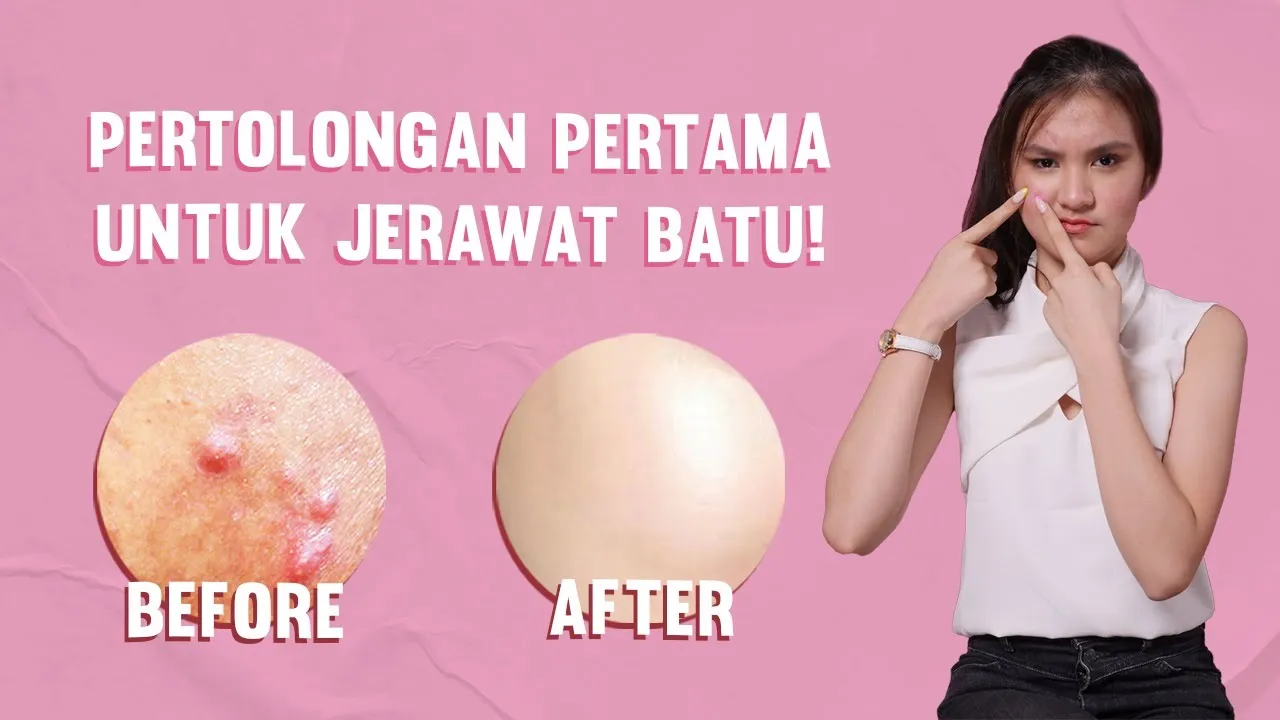 CARA CEPAT MENGHILANGKAN JERAWAT SECARA ALAMI | MENGATASI JERAWAT DENGAN BAWANG PUTIH. 