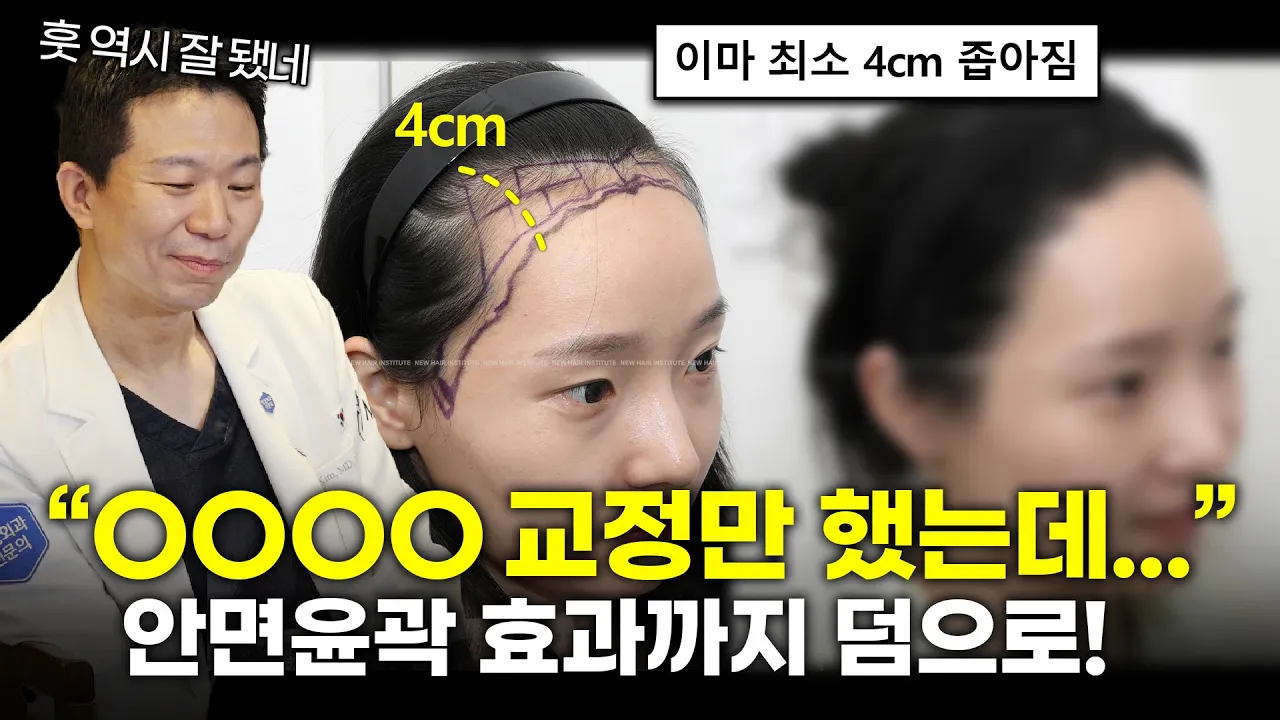 안면윤곽 효과까지 덤으로? 헤어라인 교정 "실제 전후 차이"