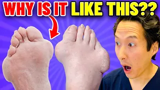 Hammerhead Feet! Plastic Surgeon Reacts to MY FEET ARE KILLING ME! 