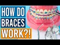 How Do Braces Work