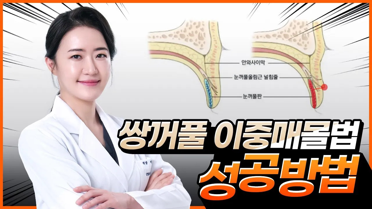 [눈] 이중매몰법, 실패하지 않으려면? 😎😎