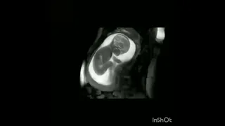 سبحان الله كيف يتحرك الجنين في بطن امه   دندنها