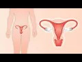 Abdominal Hysterectomy CPT code - simplify medical coding