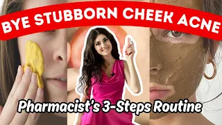 How To Fix CHEEK ACNE That Won t Go Away in 3 Steps Meaning Causes Treatment Home Remedies
