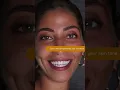 What qualities should a good veneers have
