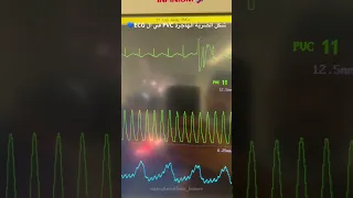 فيديو عملي لشكل الضربة الهاجرة PVC في ال ECG تعلم تخطيط القلب الكهربائي يوميات مخدر  فيديو عملي لشكل الضربة الهاجرة PVC في ال ECG تعلم تخطيط القلب الكهربائي يوميات مخدر