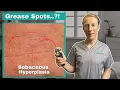 How to Get Rid of Sebaceous Hyperplasia Complete Guide to Sebaceous Hyperplasia