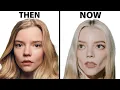 Anya Taylor-Joy s NEW FACE Plastic Surgery Analysis